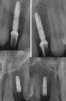 OsseoSpeed S (3.0) - 5